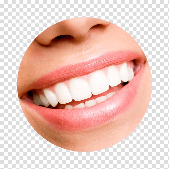 Tooth whitening Cosmetic dentistry Veneer, others transparent background PNG clipart