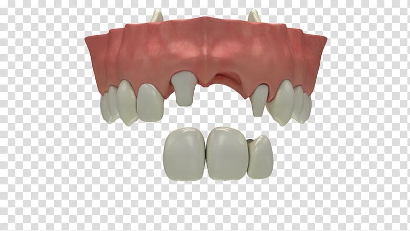 Tooth loss Dental implant Dentistry Human tooth, others transparent background PNG clipart