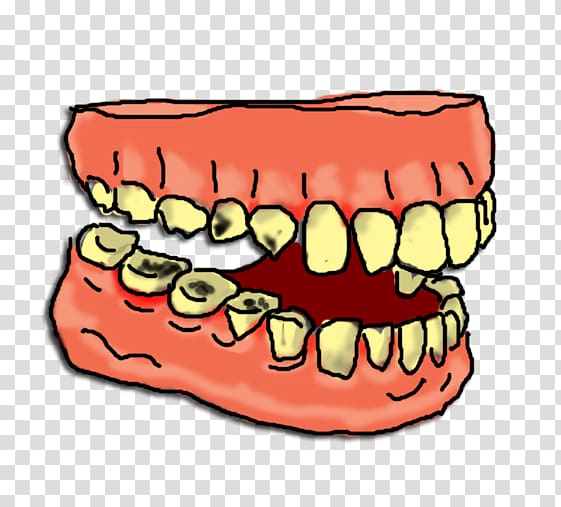 Tooth decay Tooth pathology , Chickie transparent background PNG clipart