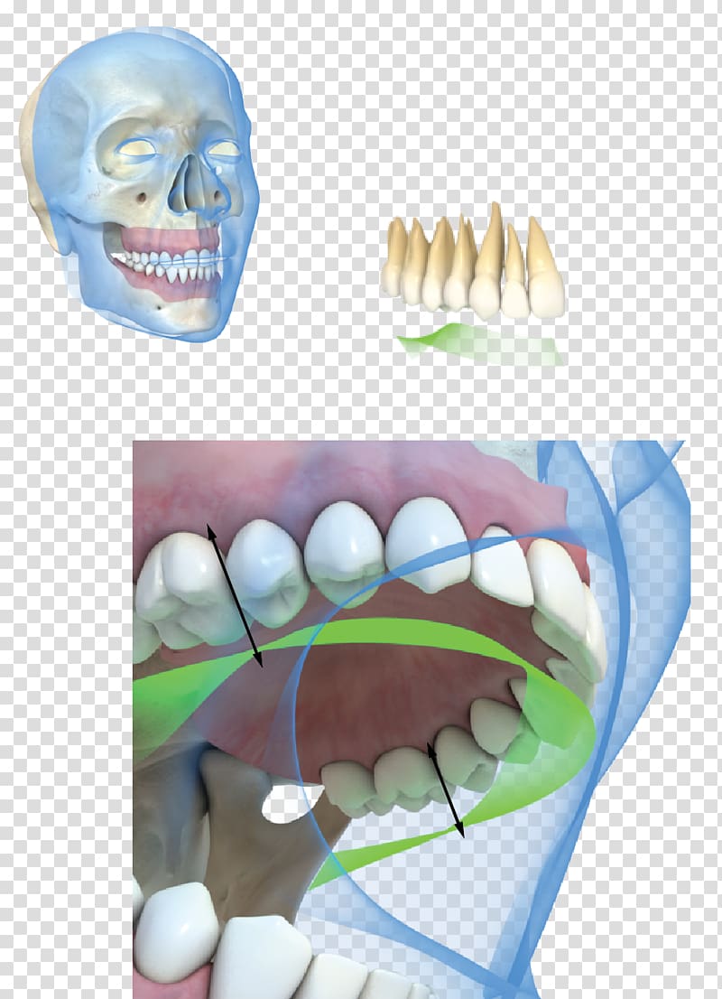 Tooth Dental implant Occlusion Gums, Strips Board transparent background PNG clipart