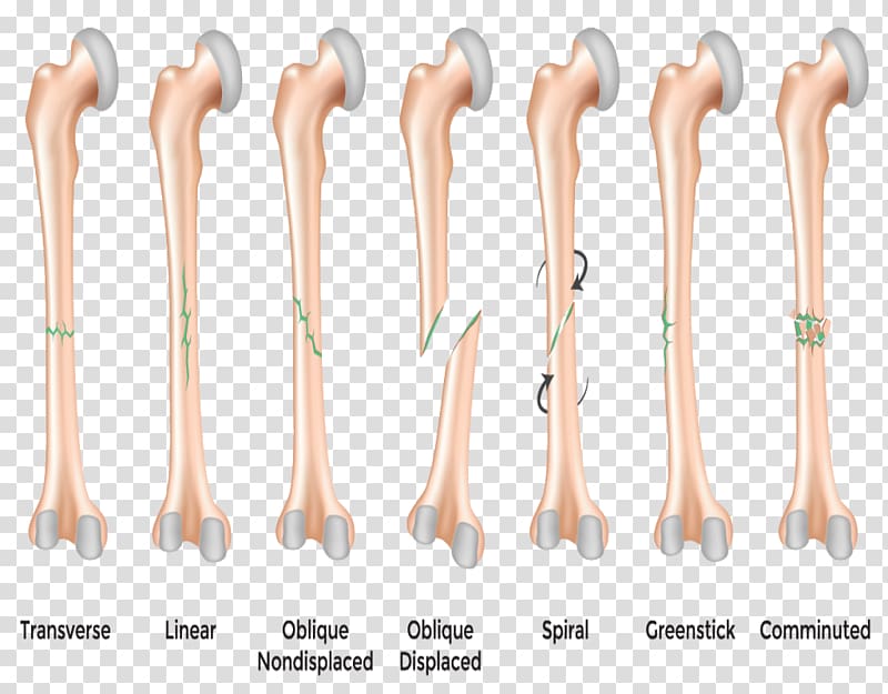 Bone fracture Greenstick fracture Stress fracture Hip fracture, Fracture transparent background PNG clipart
