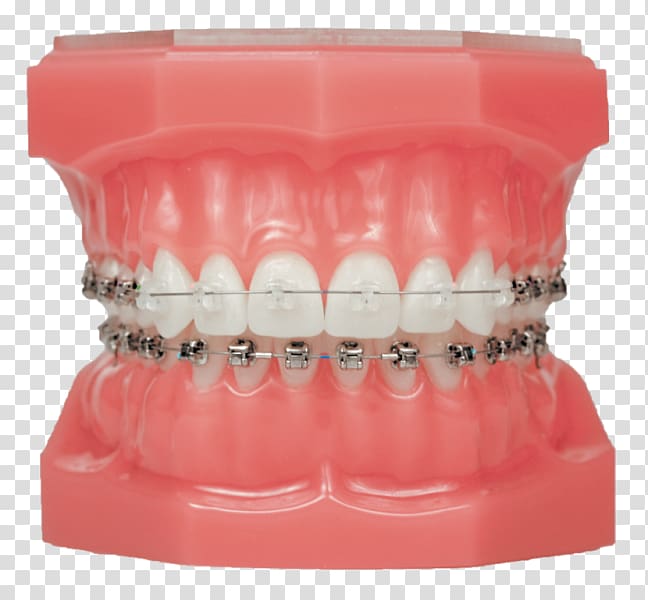 Damon system Dental braces Clear aligners Orthodontics Self-ligating bracket, invisalign transparent background PNG clipart