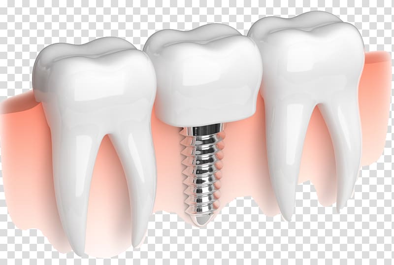 Dental implant Dentistry Dentures Bridge, Dissolve transparent background PNG clipart
