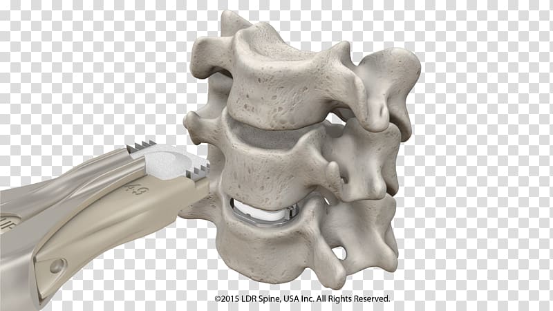 Intervertebral disc arthroplasty Anterior cervical discectomy and fusion Spinal fusion Implant, spine transparent background PNG clipart