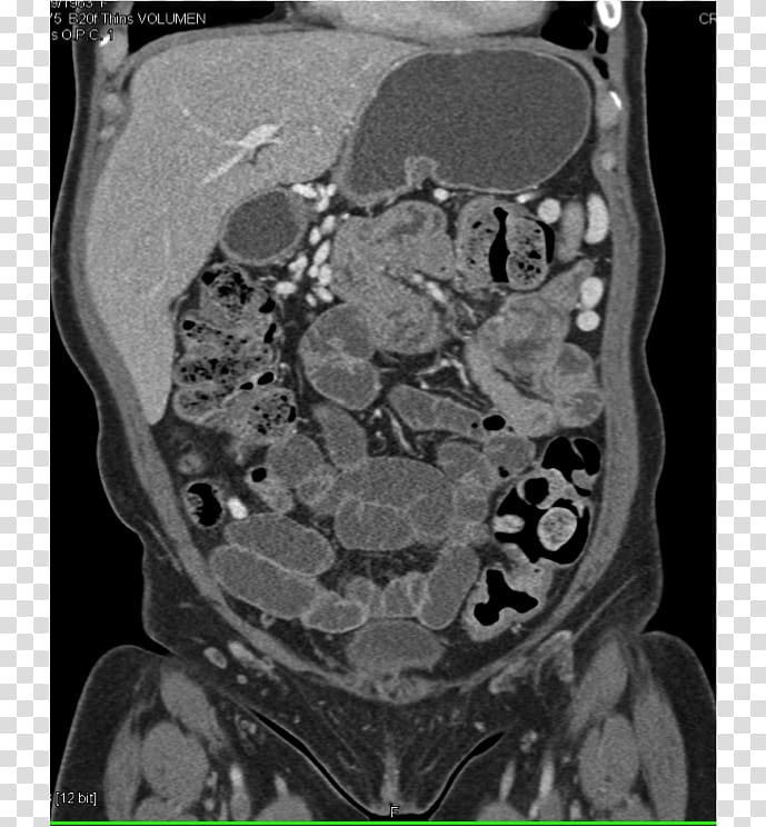 Computed tomography Radiology Medical radiography X-ray, Carcinoid transparent background PNG clipart