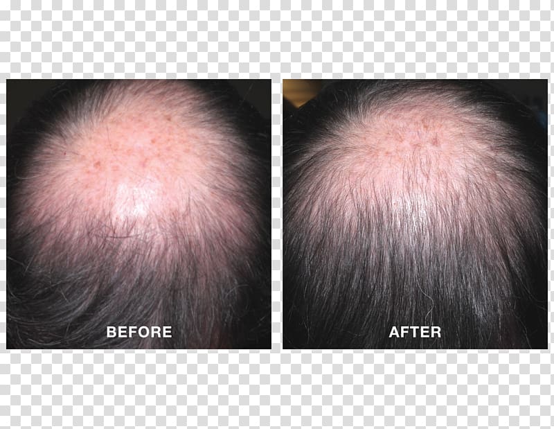 Minoxidil Management of hair loss Platelet-rich plasma Finasteride, hair transparent background PNG clipart
