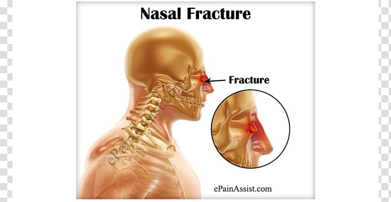 Nasal fracture Nose Nasal bone Bone fracture Surgery, headache transparent background PNG clipart