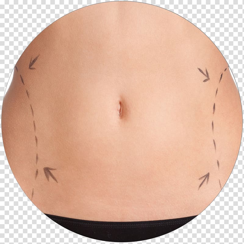 Stretch marks Abdomen Abdominoplasty Navel Hip, beauty clinic transparent background PNG clipart