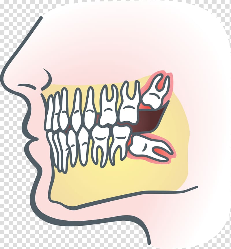 Wisdom tooth Dental extraction Impacted wisdom teeth Dentistry Tooth impaction, anatomic of teeth transparent background PNG clipart