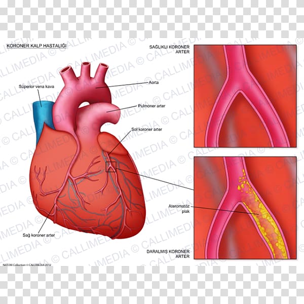 Coronary artery disease Coronary arteries Cardiology Cardiovascular disease, heart transparent background PNG clipart