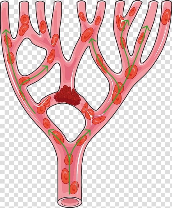Myocardial infarction Artery Cardiology Atheroma, myocardial infarction icon transparent background PNG clipart