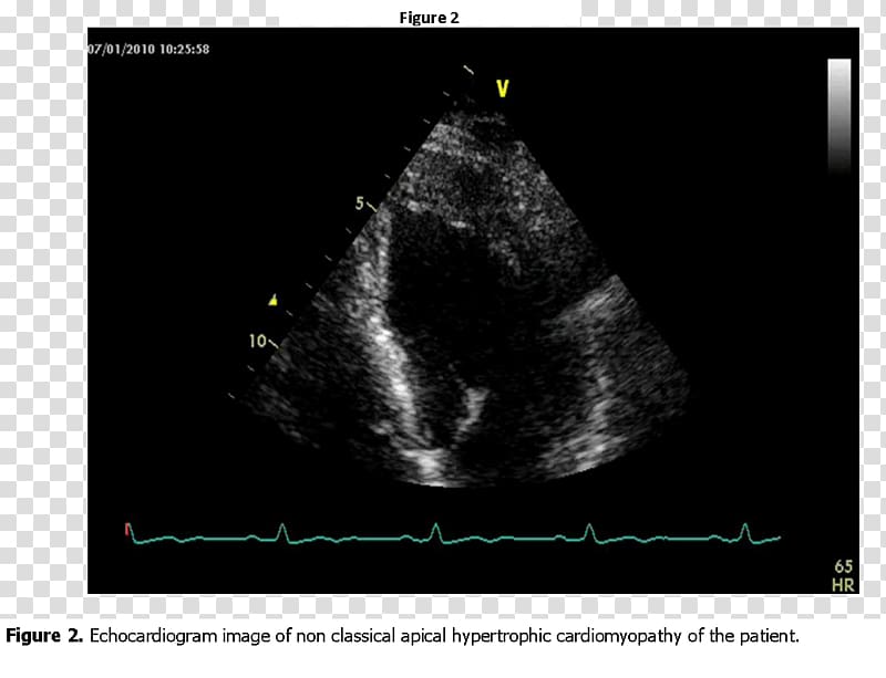 Medical imaging Radiology Medicine Phenomenon Font, hypertrophic cardiomyopathy transparent background PNG clipart