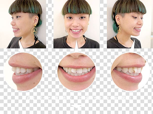 Lip Cheek Mouth Chin Jaw, Orthodontic correction transparent background PNG clipart