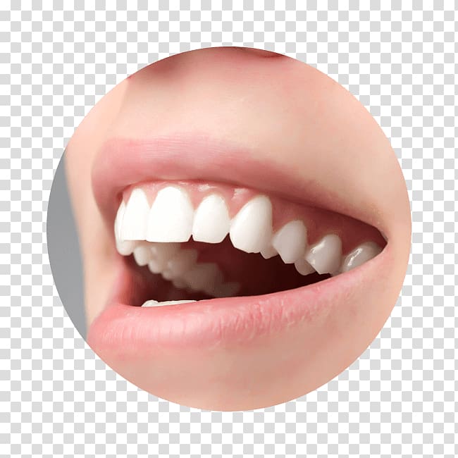 Crown Ceramic Tooth Veneer Dentistry, crown transparent background PNG clipart
