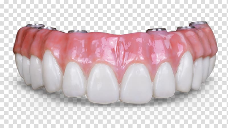 Dental implant Dentures Dentistry Prosthesis Fixed prosthodontics, bridge transparent background PNG clipart