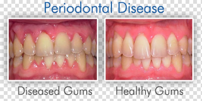 Swollen gums Gingivitis Periodontal disease Dentistry, Periodontal Disease transparent background PNG clipart