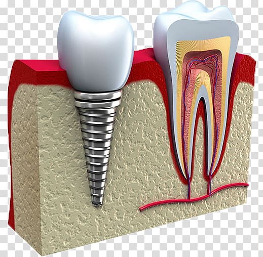 Dental implant Dentistry Tooth, Kikuzuki Dental Clinic transparent background PNG clipart