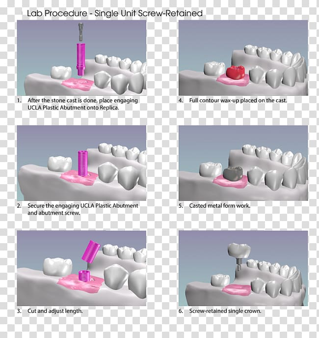 Abutment Dental implant Dentistry, dental implants transparent background PNG clipart