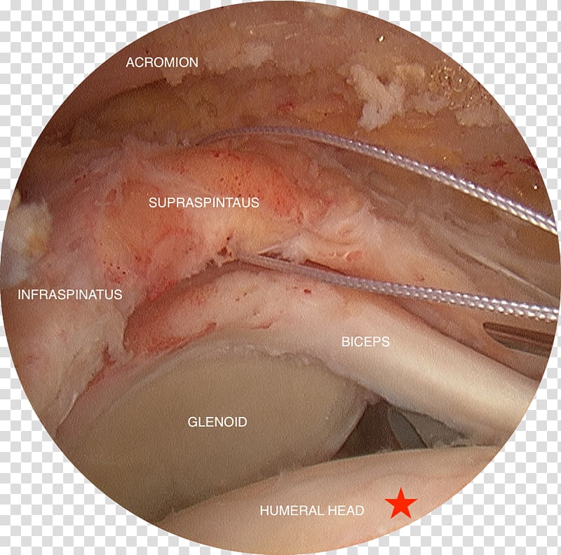 Rotator cuff tear Supraspinatus muscle Arthroscopy Surgery, infraspinatus transparent background PNG clipart