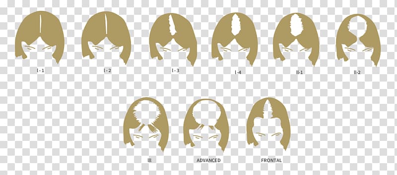 Pattern hair loss Hair transplantation Management of hair loss, hair transparent background PNG clipart