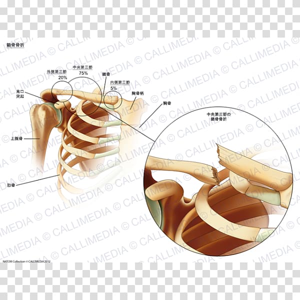 Clavicle fracture Bone fracture Sternum, Fracture transparent background PNG clipart