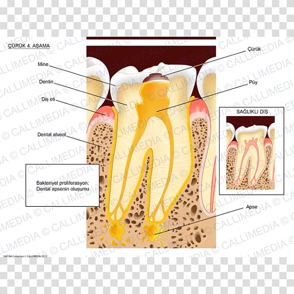 Dental abscess Tooth brushing Dentist, BACTERIA TOOTH transparent background PNG clipart