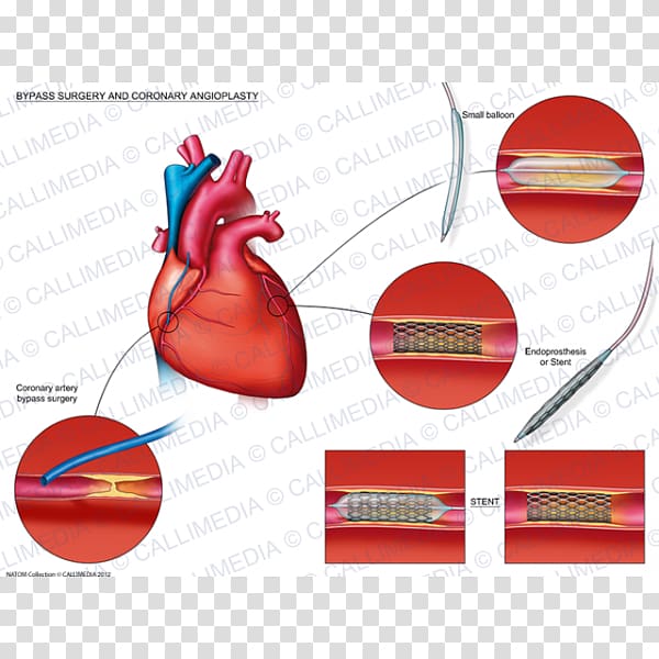 Angioplasty Heart Coronary artery bypass surgery Stenting, heart transparent background PNG clipart