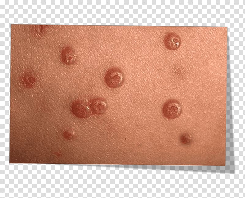 Molluscum contagiosum Skin Wheal Pediatrics Infectious disease, child transparent background PNG clipart