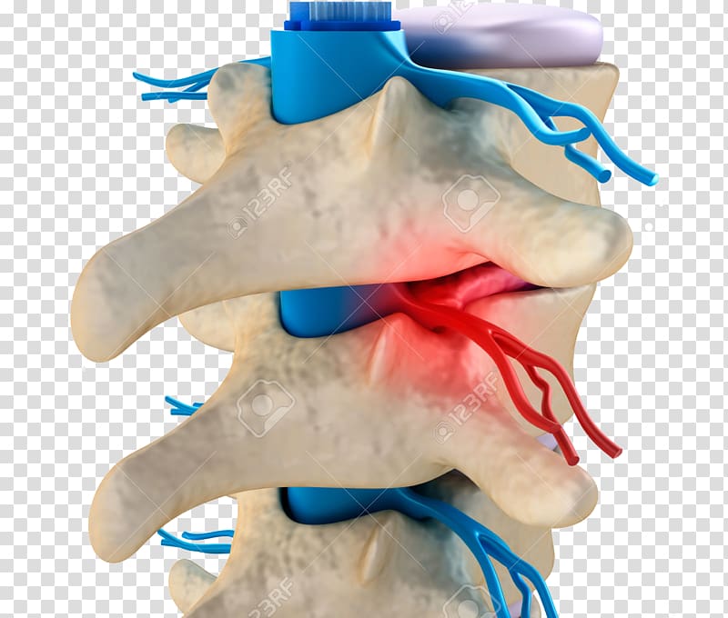 Vertebral column Vertebral subluxation Spinal disc herniation Cervical vertebrae, others transparent background PNG clipart