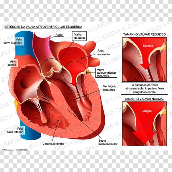 Aortic insufficiency Aorta Aortic stenosis Ventricle Aortic valve, heart transparent background PNG clipart