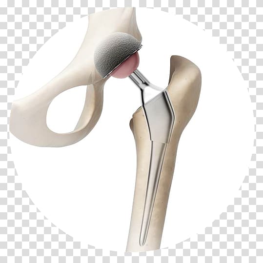 Hip replacement Prosthesis Knee replacement, artrosis de rodilla transparent background PNG clipart