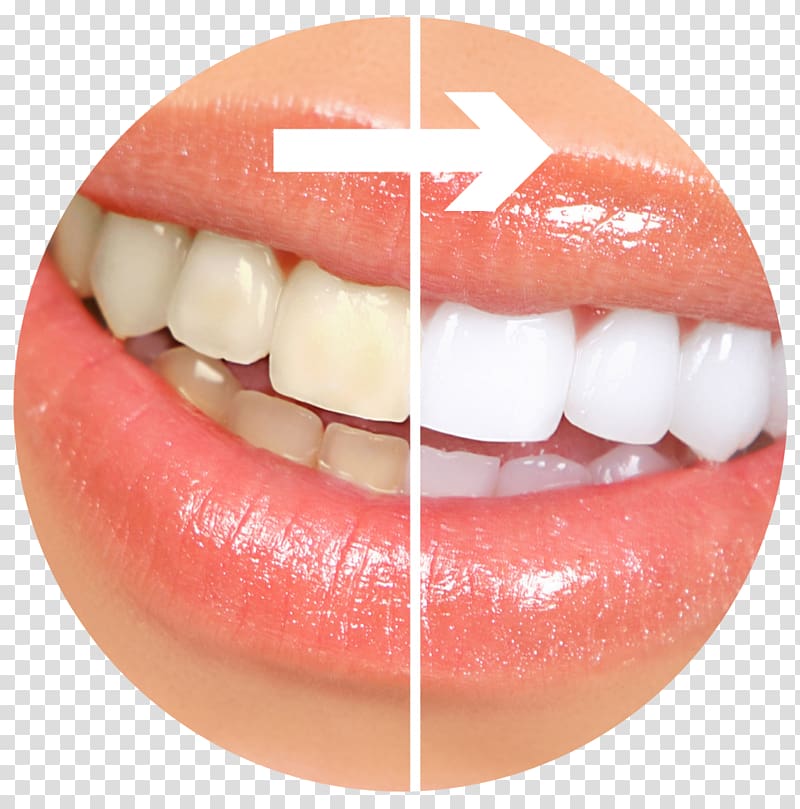 Tooth whitening Cosmetic dentistry Human tooth, toothpaste transparent background PNG clipart