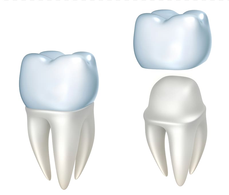 Crown Dentistry Dental restoration Bridge, teeth transparent background PNG clipart