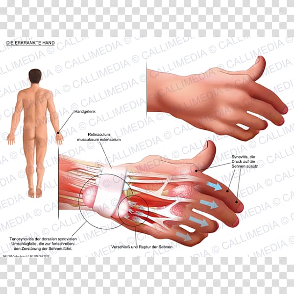 Thumb Product design Hand model Subcutaneous nodules, design transparent background PNG clipart