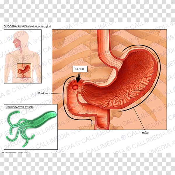 Stomach Helicobacter pylori Peptic ulcer disease Duodenum Duodenal ulcer, others transparent background PNG clipart