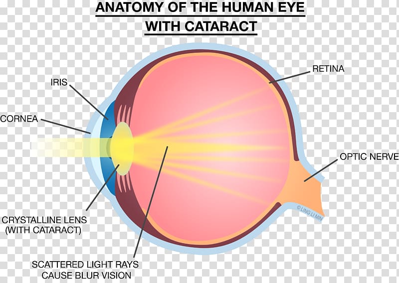 Light Eye Lens Strength Training Anatomy Cataract, light transparent background PNG clipart