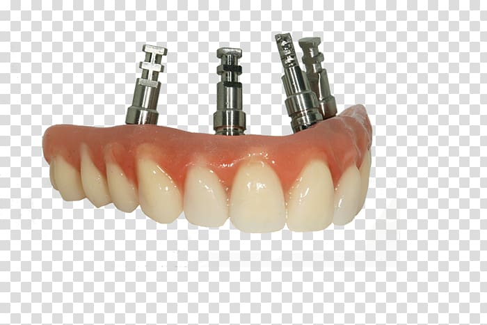 Bridge Tooth Dentures Prosthesis Dentistry, Dental Laboratory transparent background PNG clipart