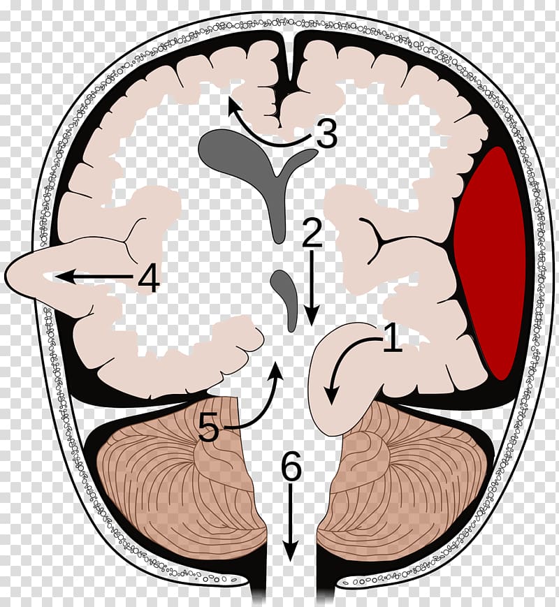 Brain herniation Intracranial pressure Brain tumor Uncus, Brain transparent background PNG clipart