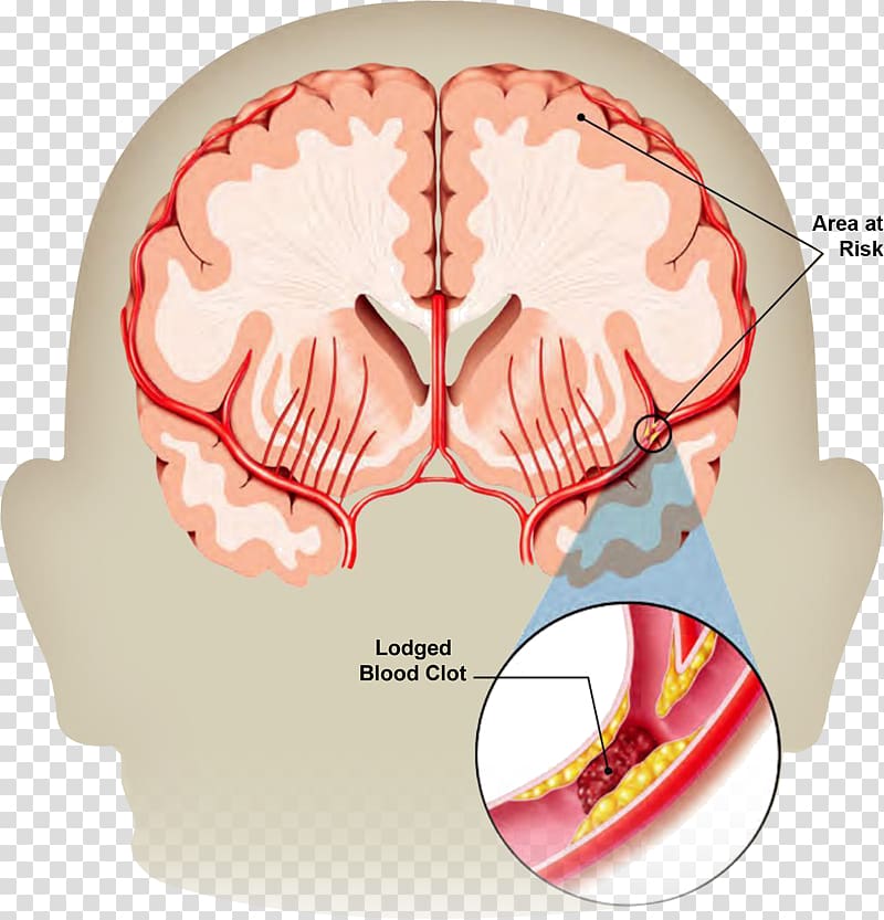 Stroke Transient ischemic attack Neurology Brain haemorrhage Health, health transparent background PNG clipart