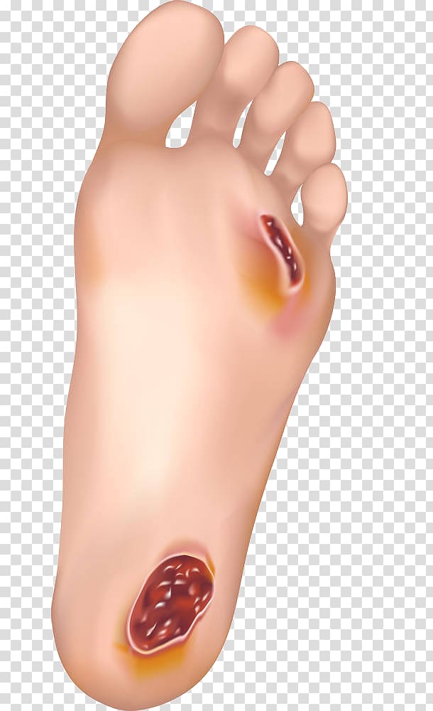 foot illustration, Diabetic foot ulcer Wound healing Skin ulcer, The dangers of high blood sugar transparent background PNG clipart