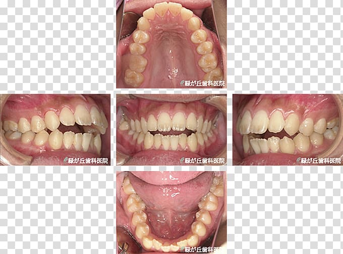 矯正歯科 Dentist Dental braces Dentition Tooth, ortho transparent background PNG clipart