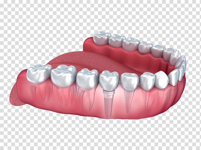 Dental implant Human tooth Dentistry, others transparent background PNG clipart