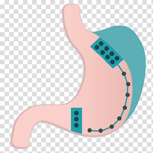 Obesity Surgery Therapy Endoscopy Medical diagnosis, Abdominal Obesity transparent background PNG clipart