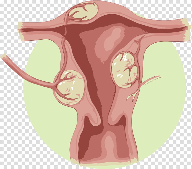Uterine fibroid Uterine artery embolization Uterus Benign tumor, others transparent background PNG clipart