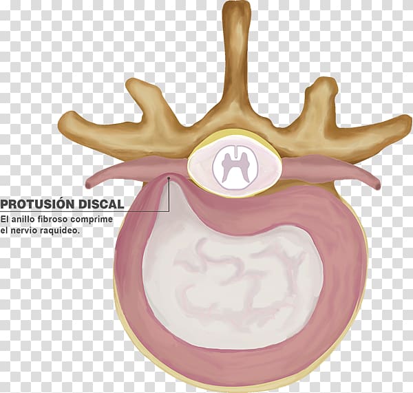 Intervertebral disc Spinal disc herniation Lumbar vertebrae Disc protrusion, columna vertebral transparent background PNG clipart