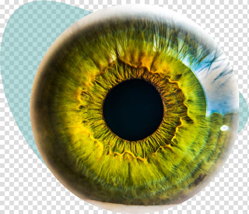 Eye surgery Eye injury LASIK Keratoconus, eyeball transparent background PNG clipart