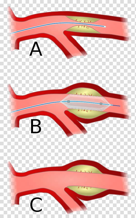 Angioplasty Percutaneous coronary intervention Coronary artery disease Interventional radiology, Baremetal Stent transparent background PNG clipart