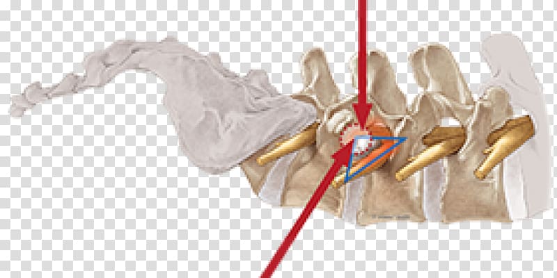 Vertebral column Surgery Spinal disc herniation Endoscopy Intervertebral foramen, Endoscopic Endonasal Surgery transparent background PNG clipart