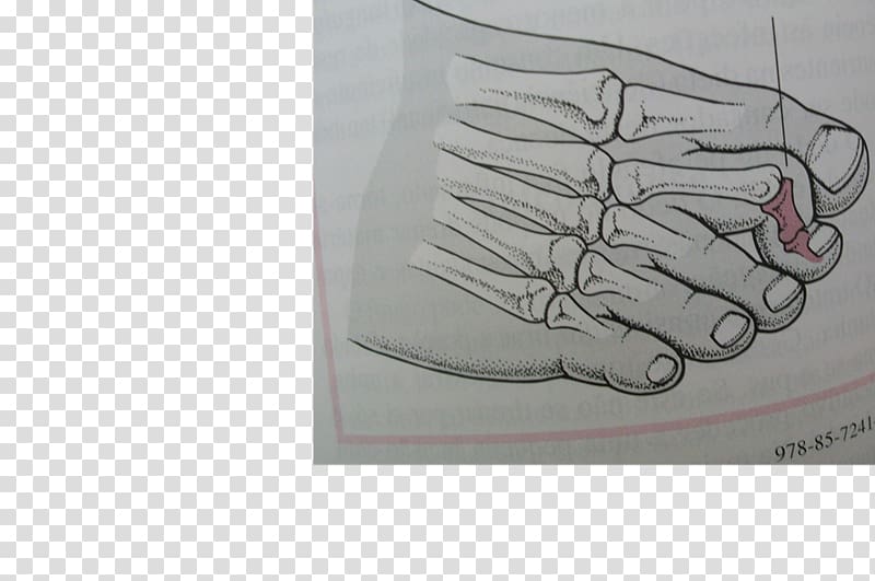 Digit Hammer toe Foot Mallet finger, hand transparent background PNG clipart