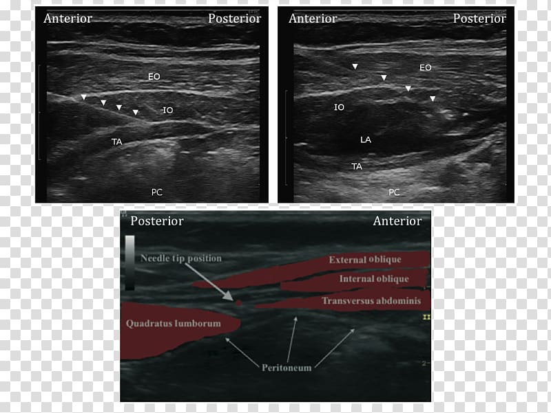 Quadratus lumborum muscle Lumbar triangle Ultrasonography Transverse abdominal muscle Ultrasound, oblique line transparent background PNG clipart